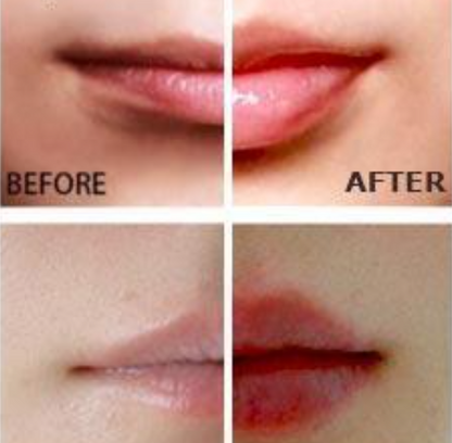 Apex FullLip Plumping Device — Hyaluronic Lip Enhancer